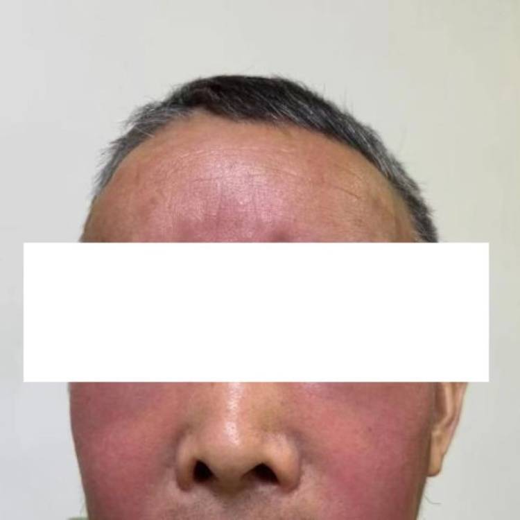 杭州发生多起<strong></p>
<p>搜狐证券</strong>！面部肿成“馒头”！6小时内处理很重要