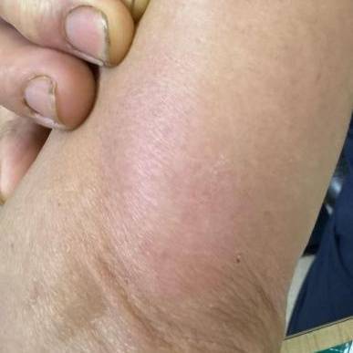 杭州发生多起<strong></p>
<p>搜狐证券</strong>！面部肿成“馒头”！6小时内处理很重要