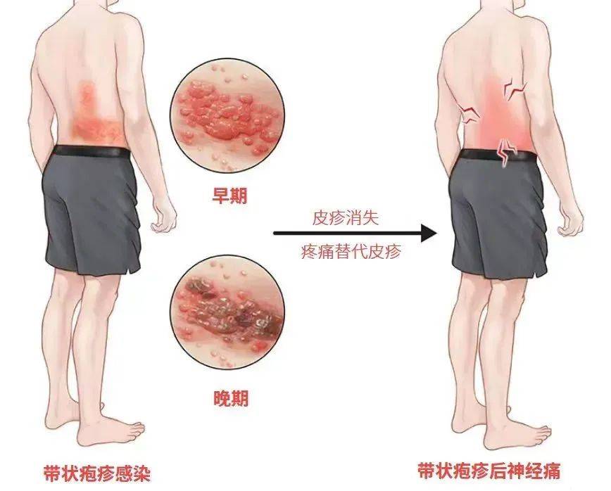 一旦感染终身携带<strong></p>
<p>搜狐证券</strong>！深圳疾控提醒：这4类人要注意