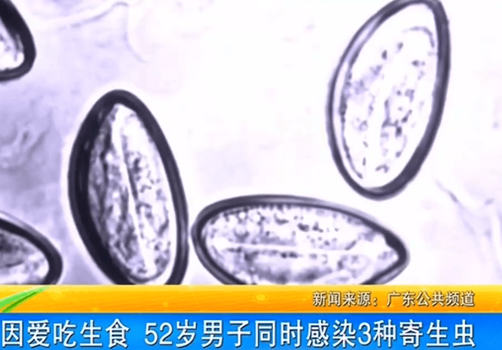 女子体内排出10米长绦虫<strong></p>
<p>美林证券</strong>！原是两年前旅游时吃了这种食物